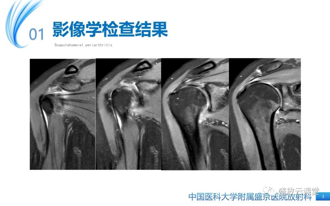 影像PPT - 【PPT】肩关节周围炎(肩周炎)-3