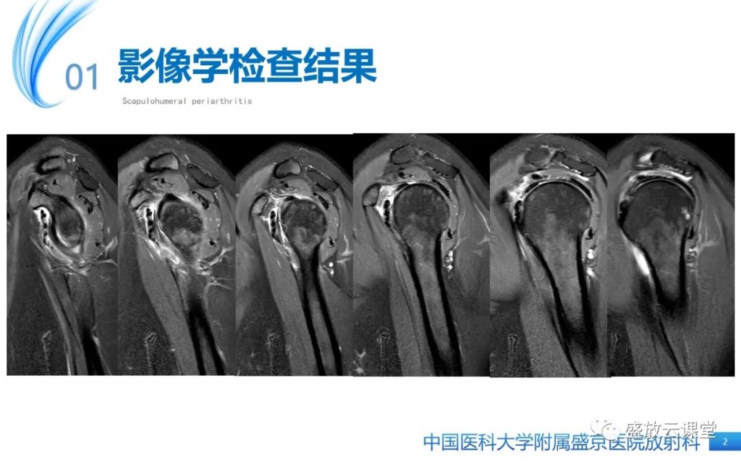 影像PPT - 【PPT】肩关节周围炎(肩周炎)-2