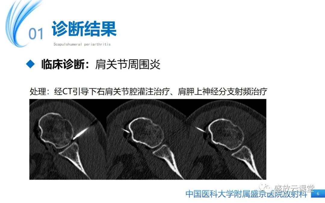 影像PPT - 【PPT】肩关节周围炎(肩周炎)-6