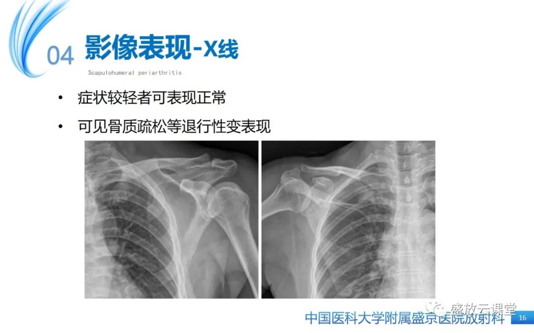影像PPT - 【PPT】肩关节周围炎(肩周炎)-16