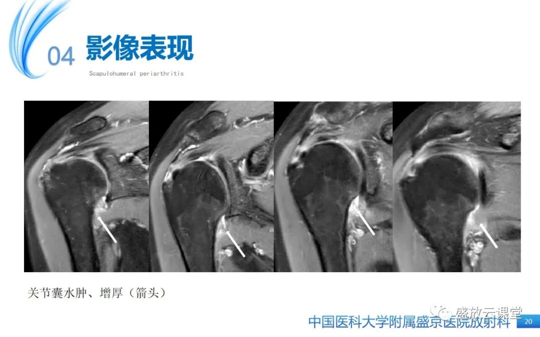 影像PPT - 【PPT】肩关节周围炎(肩周炎)-20