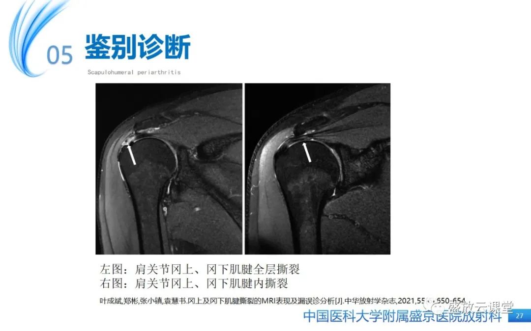 影像PPT - 【PPT】肩关节周围炎(肩周炎)-27
