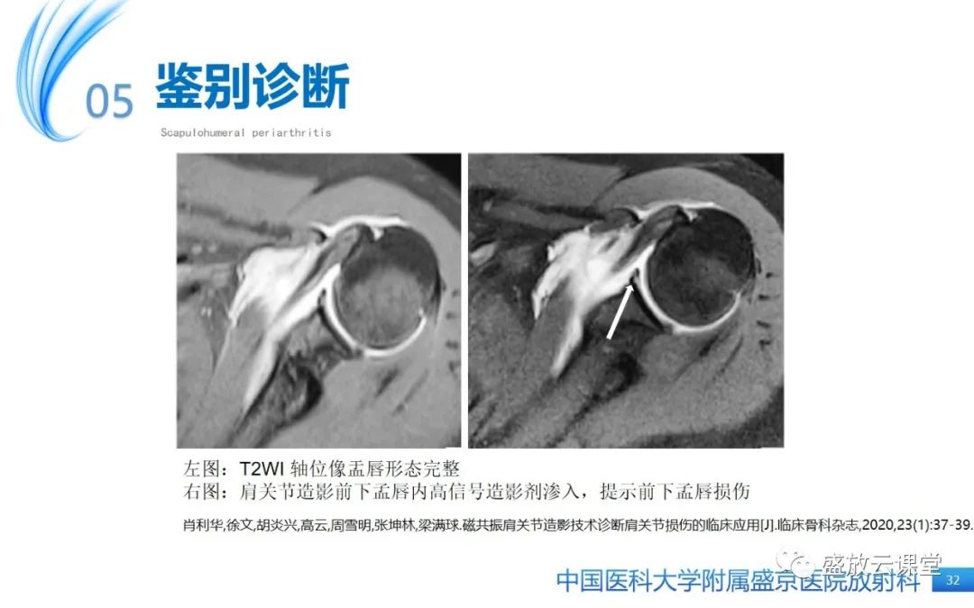 影像PPT - 【PPT】肩关节周围炎(肩周炎)-32