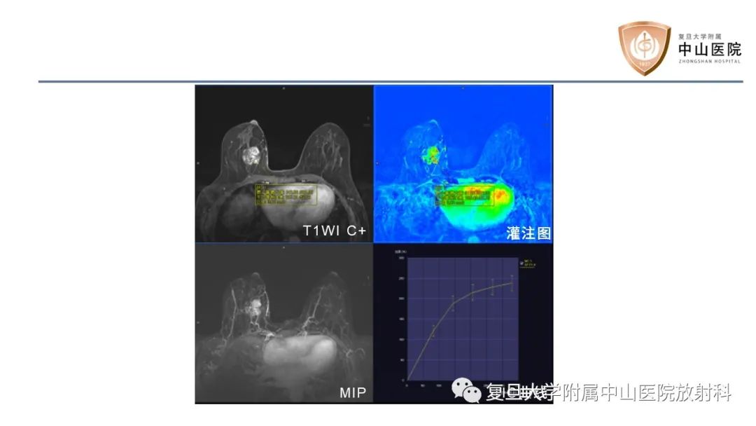 影像PPT - 【病例】乳腺粘液腺癌1例MR影像-5
