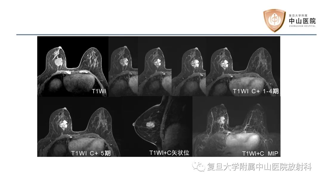 影像PPT - 【病例】乳腺粘液腺癌1例MR影像-4