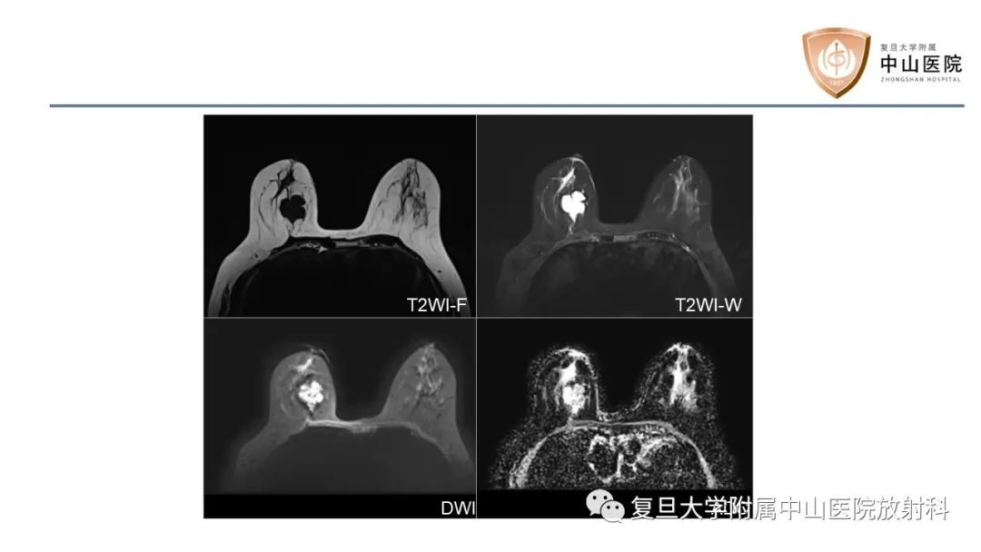 影像PPT - 【病例】乳腺粘液腺癌1例MR影像-3