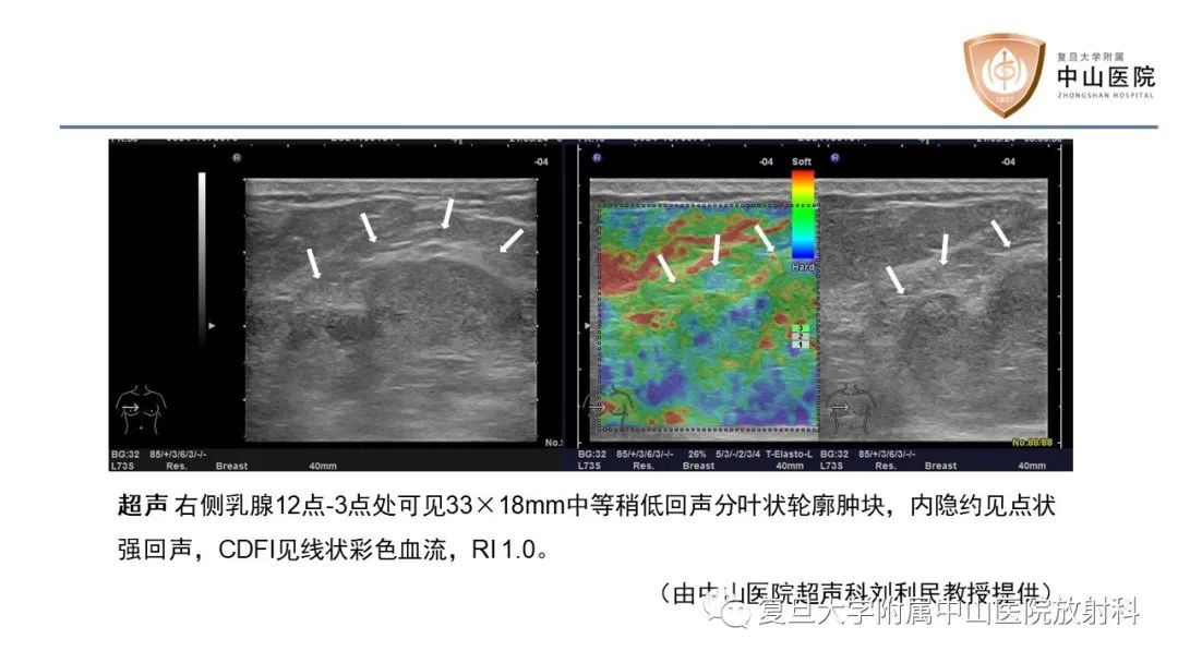 影像PPT - 【病例】乳腺粘液腺癌1例MR影像-6