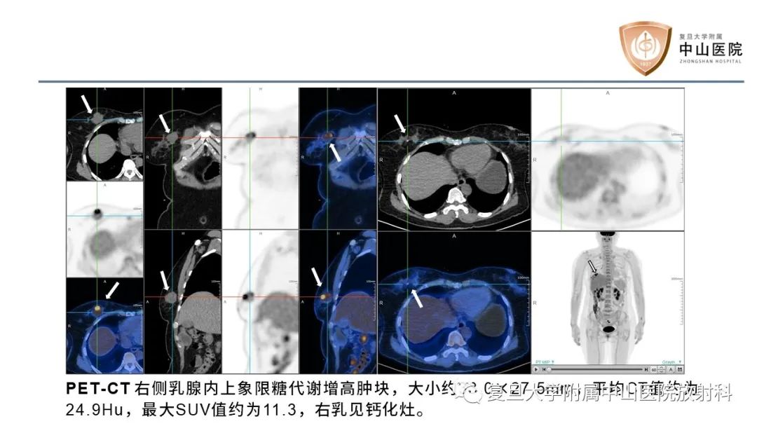 影像PPT - 【病例】乳腺粘液腺癌1例MR影像-7