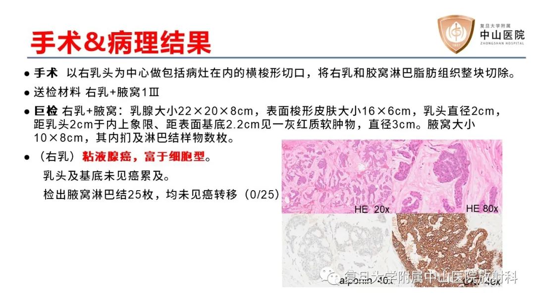 影像PPT - 【病例】乳腺粘液腺癌1例MR影像-8