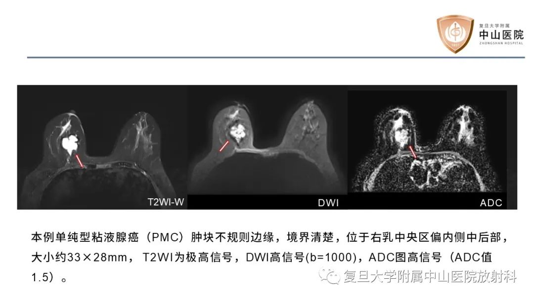 影像PPT - 【病例】乳腺粘液腺癌1例MR影像-12