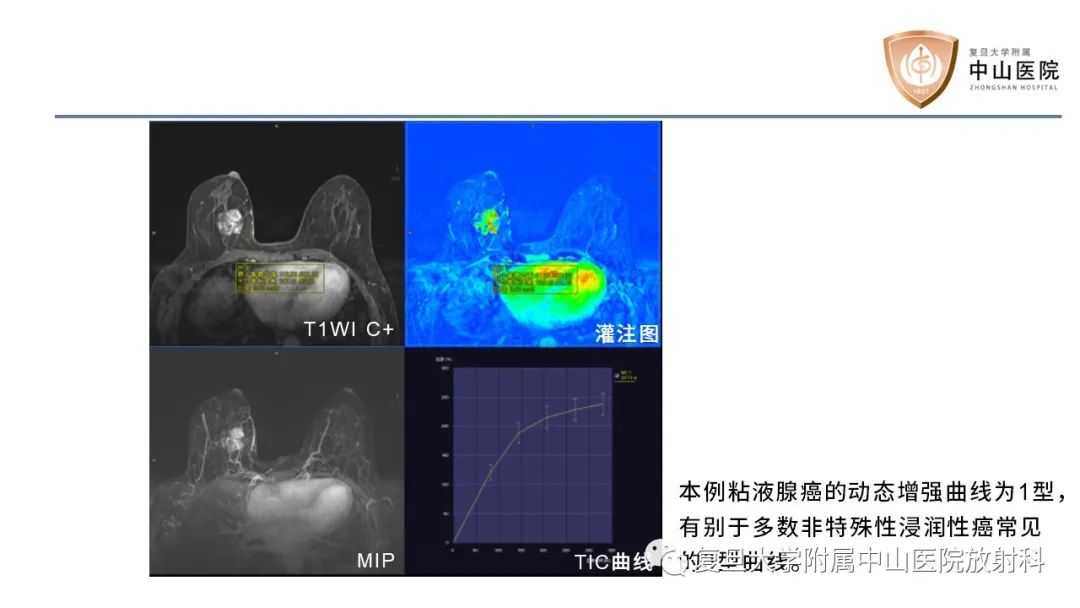 影像PPT - 【病例】乳腺粘液腺癌1例MR影像-14