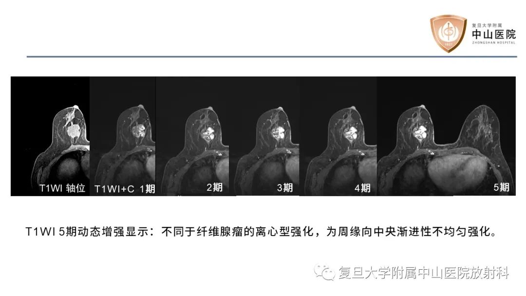 影像PPT - 【病例】乳腺粘液腺癌1例MR影像-13