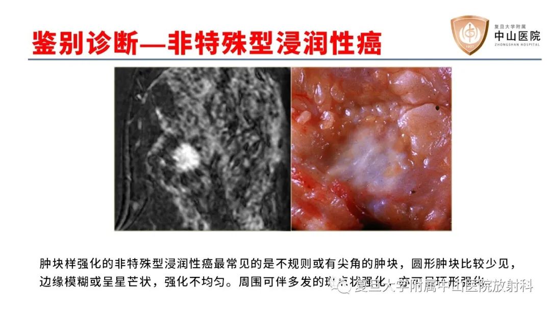 影像PPT - 【病例】乳腺粘液腺癌1例MR影像-18