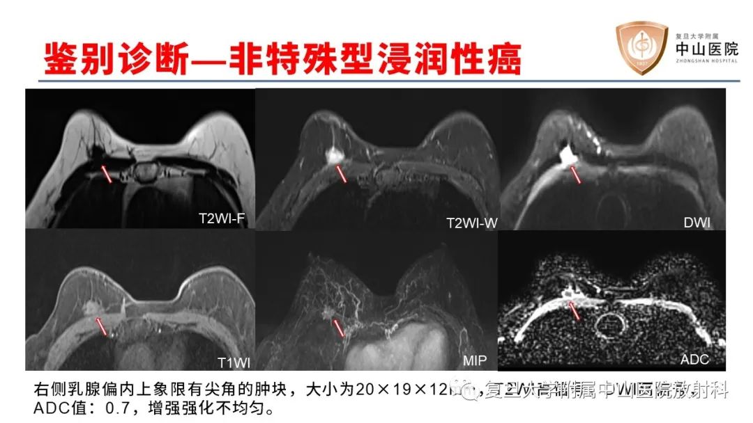 影像PPT - 【病例】乳腺粘液腺癌1例MR影像-19