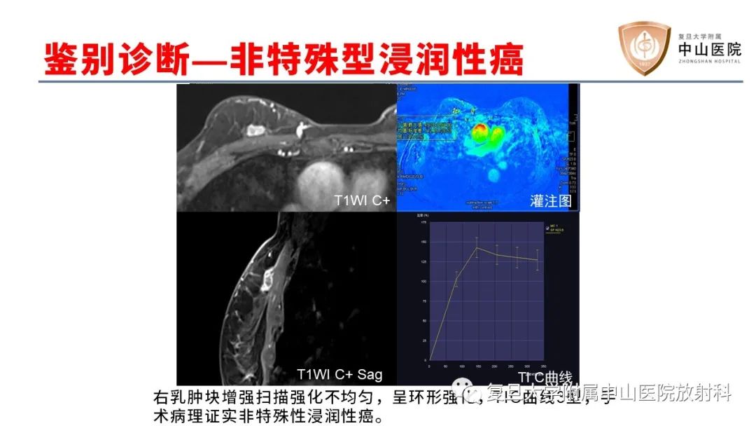 影像PPT - 【病例】乳腺粘液腺癌1例MR影像-20
