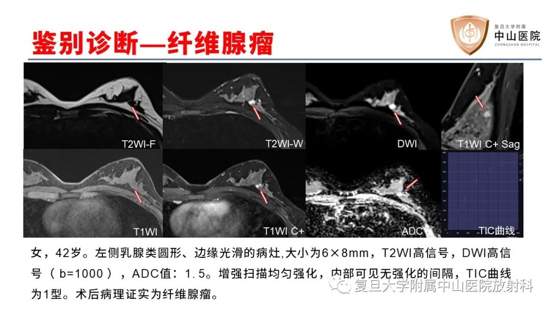 影像PPT - 【病例】乳腺粘液腺癌1例MR影像-22