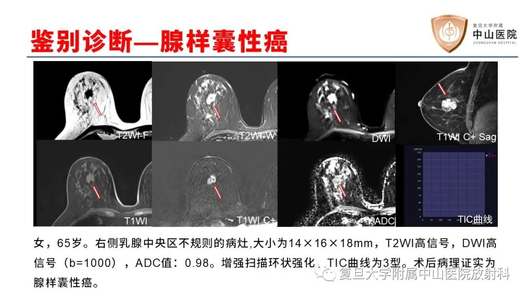 影像PPT - 【病例】乳腺粘液腺癌1例MR影像-23