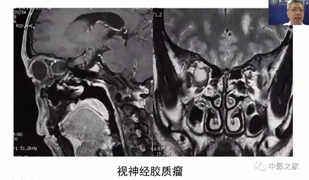 影像PPT - 【PPT】眶颅沟通性病变影像诊断-9