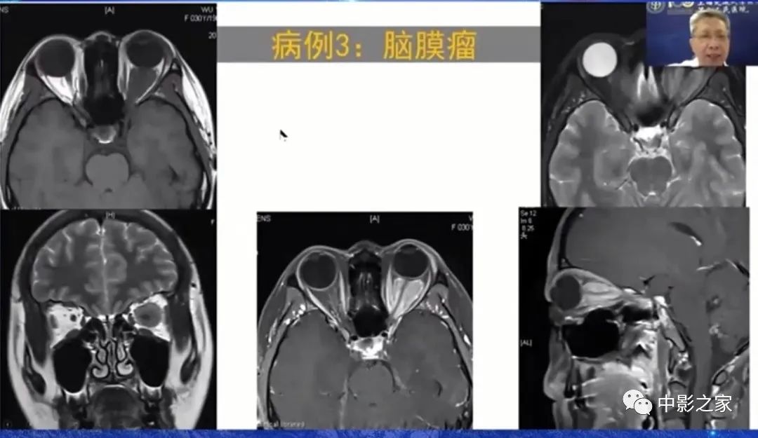 影像PPT - 【PPT】眶颅沟通性病变影像诊断-17