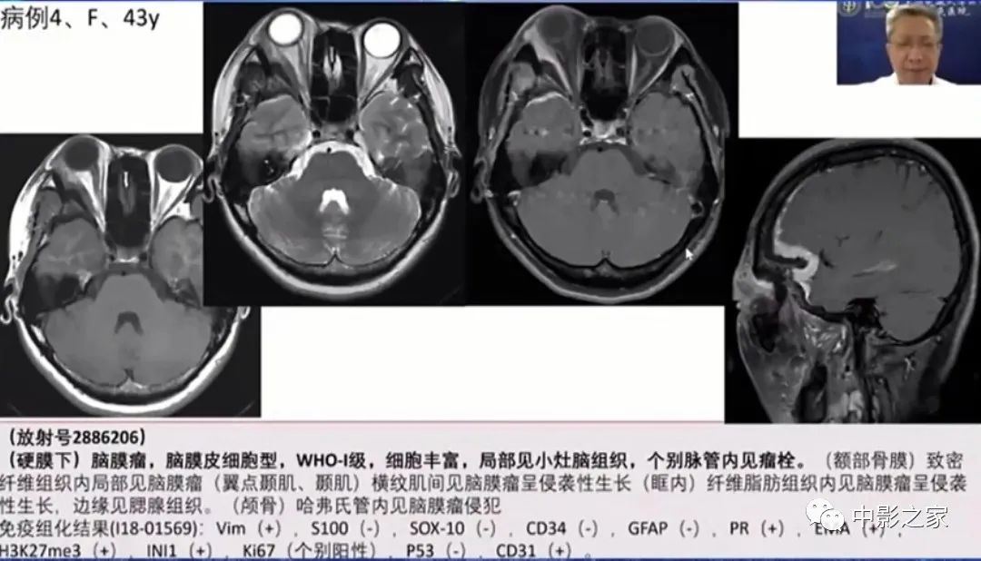 影像PPT - 【PPT】眶颅沟通性病变影像诊断-19