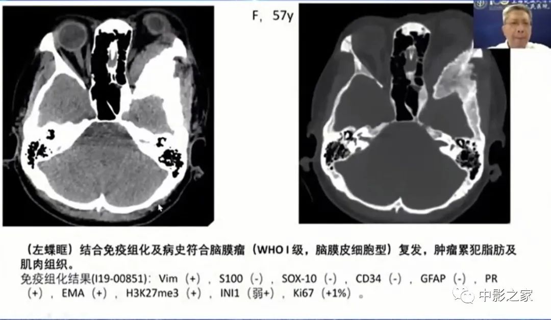 影像PPT - 【PPT】眶颅沟通性病变影像诊断-30