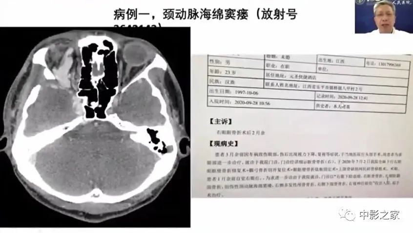 影像PPT - 【PPT】眶颅沟通性病变影像诊断-32