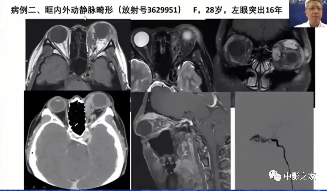 影像PPT - 【PPT】眶颅沟通性病变影像诊断-33