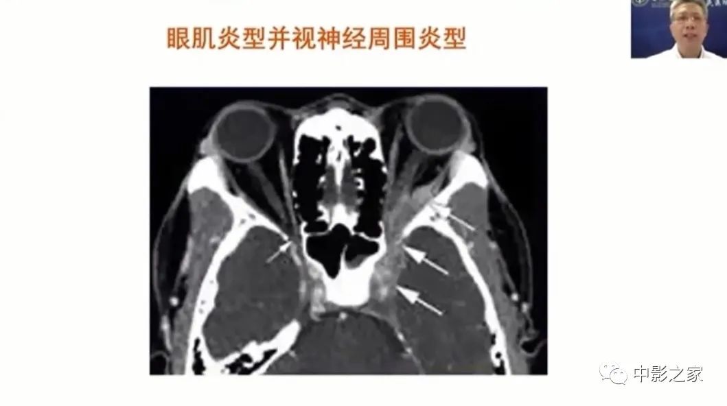 影像PPT - 【PPT】眶颅沟通性病变影像诊断-34