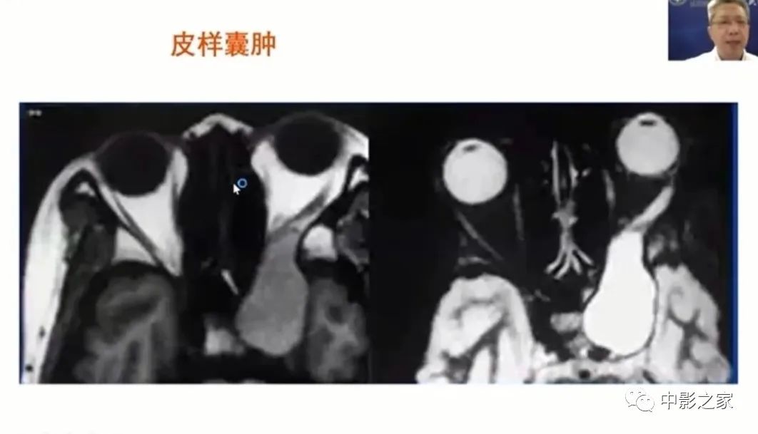 影像PPT - 【PPT】眶颅沟通性病变影像诊断-35