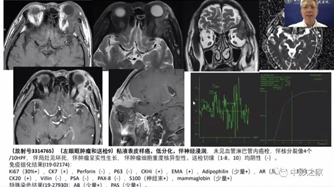 影像PPT - 【PPT】眶颅沟通性病变影像诊断-37