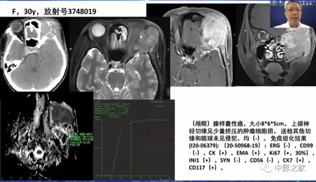 影像PPT - 【PPT】眶颅沟通性病变影像诊断-38