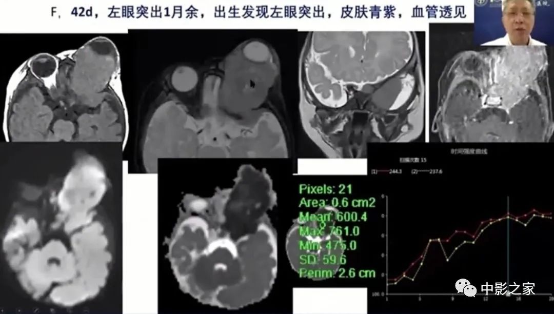 影像PPT - 【PPT】眶颅沟通性病变影像诊断-40