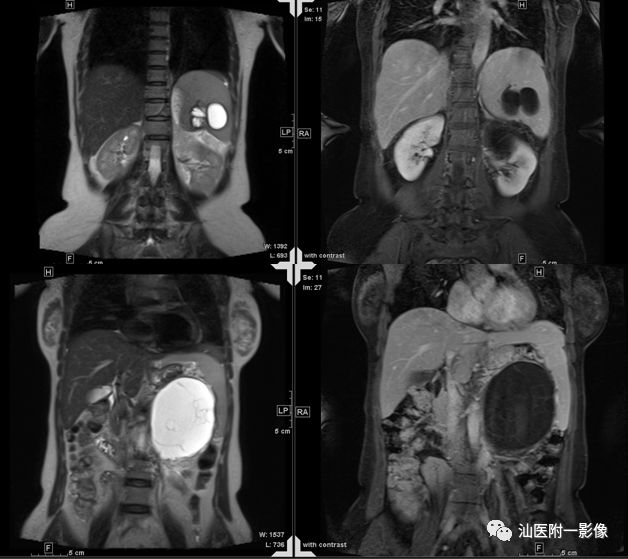 影像PPT - 【病例】胰腺真性囊肿 VS 假性囊肿-23