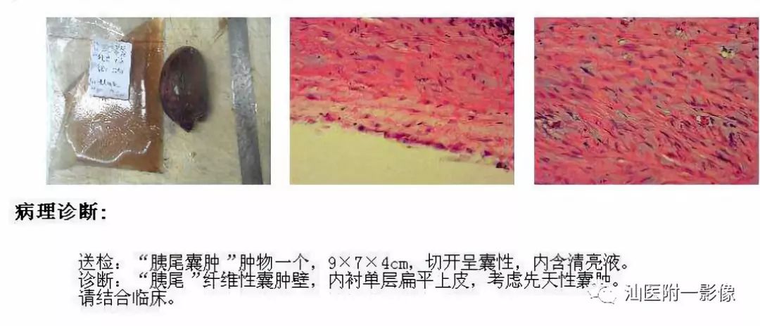 影像PPT - 【病例】胰腺真性囊肿 VS 假性囊肿-25
