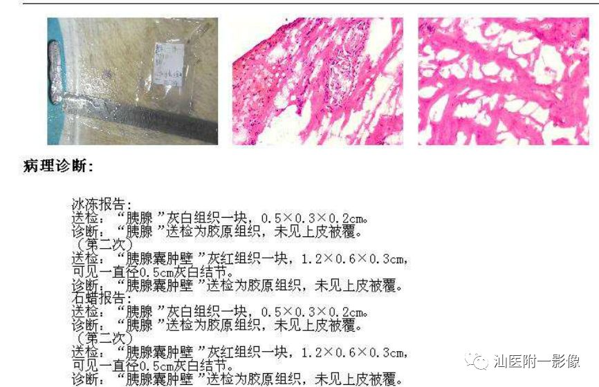 影像PPT - 【病例】胰腺真性囊肿 VS 假性囊肿-28