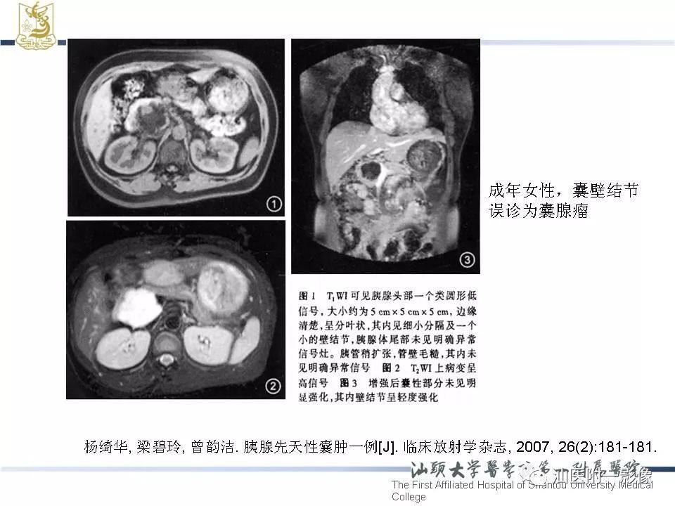 影像PPT - 【病例】胰腺真性囊肿 VS 假性囊肿-33