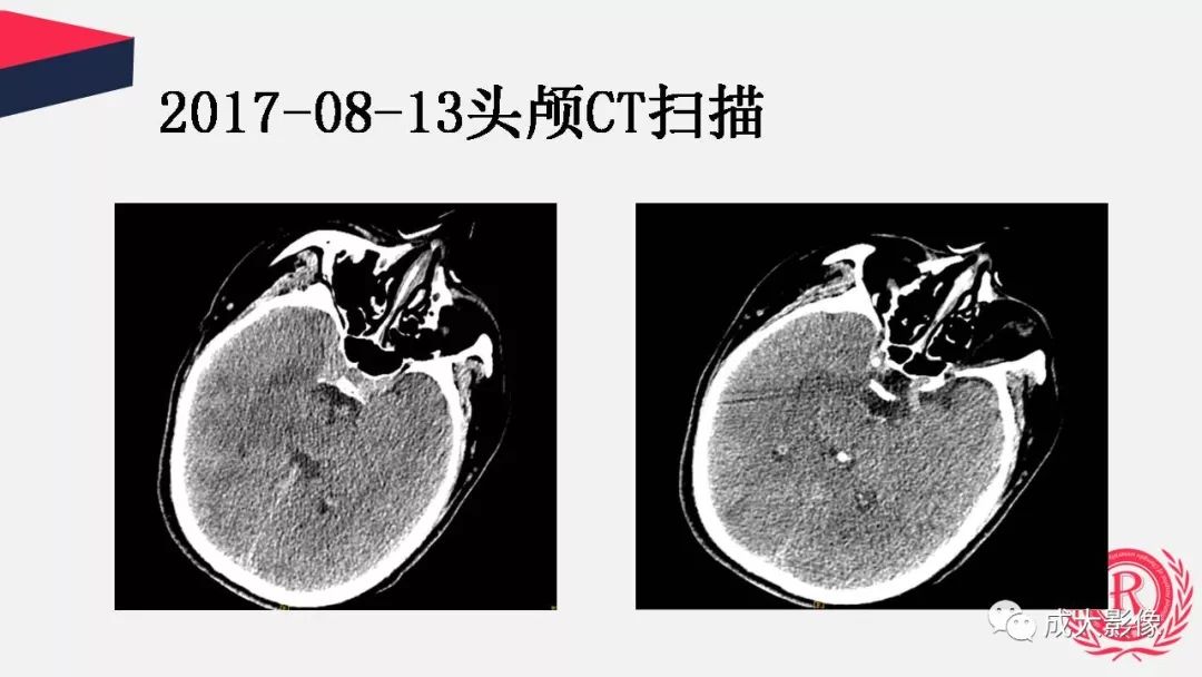 影像PPT - 【PPT】病毒性脑炎影像表现-3