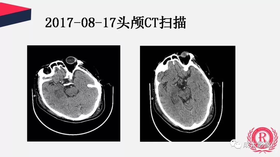 影像PPT - 【PPT】病毒性脑炎影像表现-4