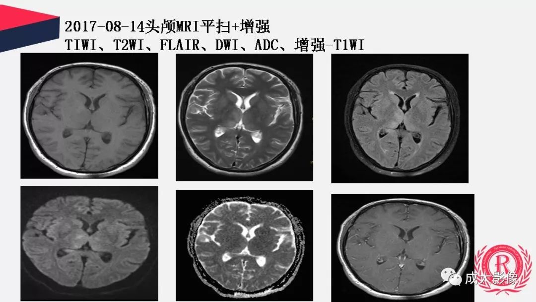 影像PPT - 【PPT】病毒性脑炎影像表现-6