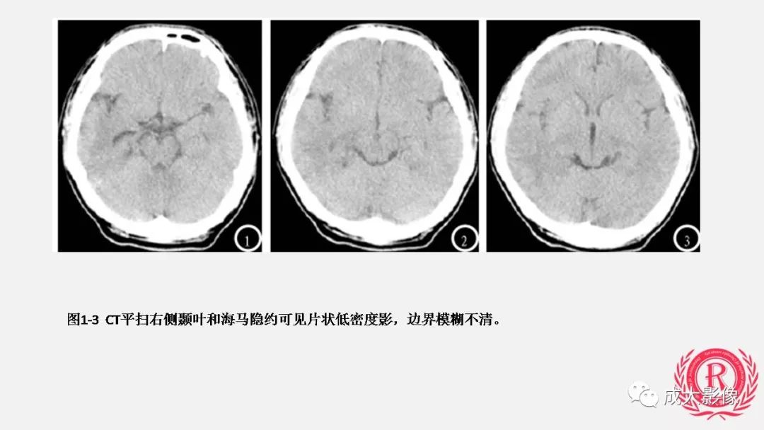 影像PPT - 【PPT】病毒性脑炎影像表现-14