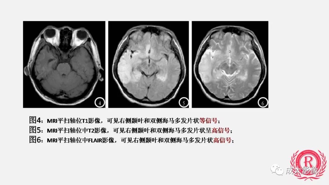影像PPT - 【PPT】病毒性脑炎影像表现-15