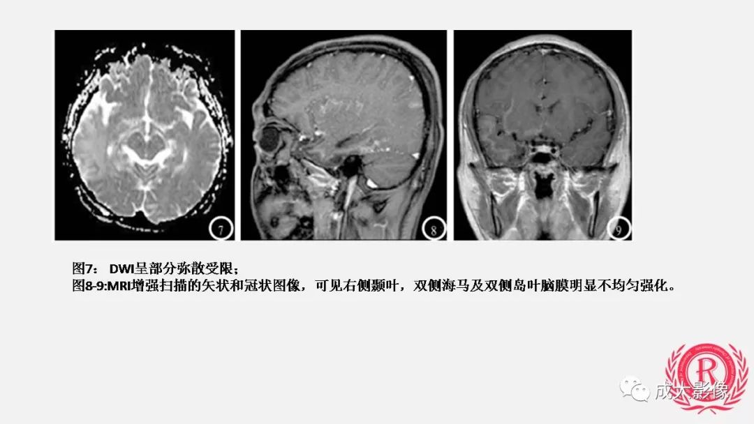 影像PPT - 【PPT】病毒性脑炎影像表现-16