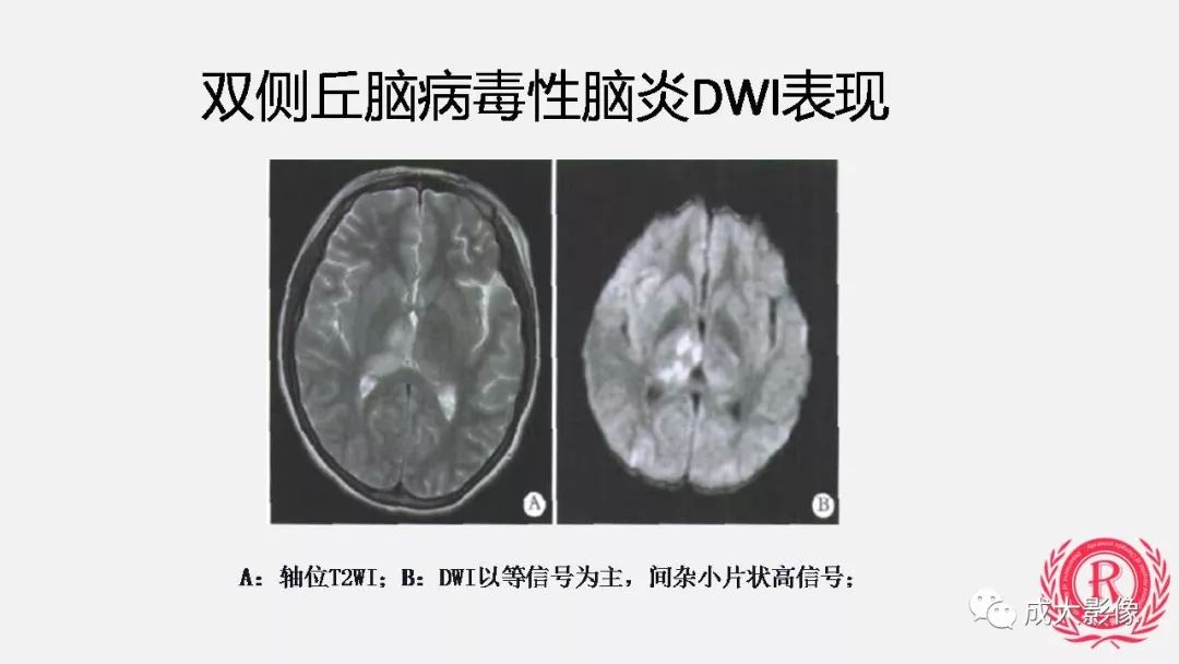 影像PPT - 【PPT】病毒性脑炎影像表现-17