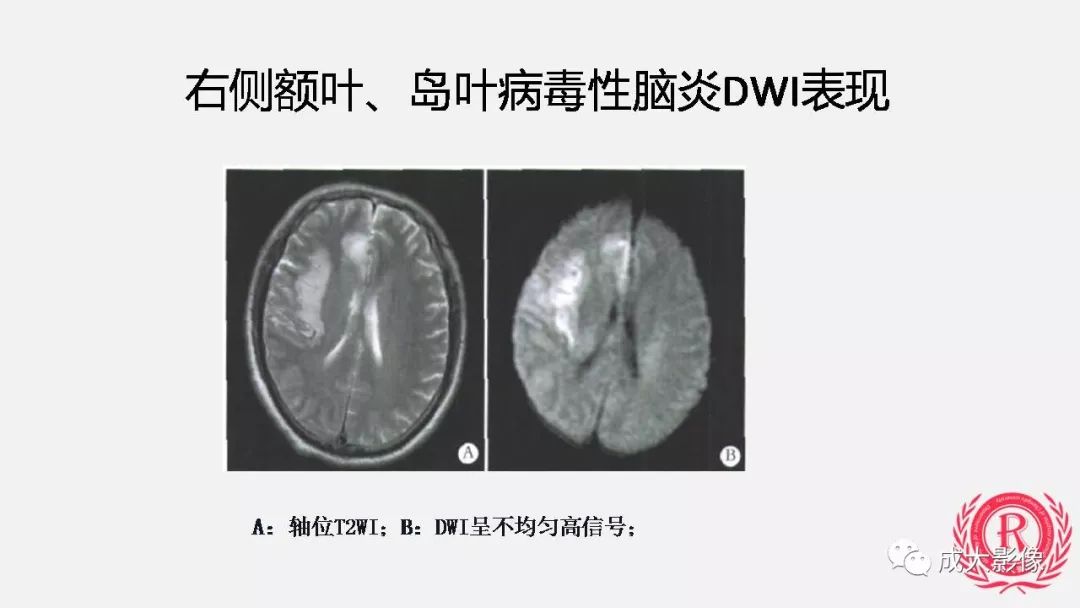 影像PPT - 【PPT】病毒性脑炎影像表现-18