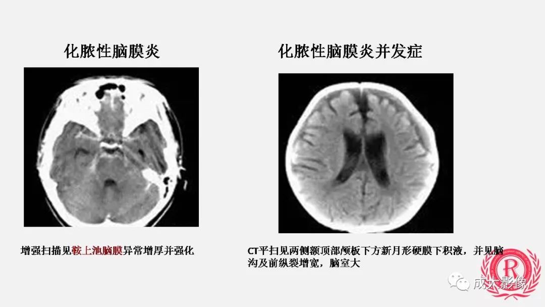 影像PPT - 【PPT】病毒性脑炎影像表现-23