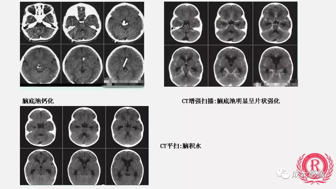 影像PPT - 【PPT】病毒性脑炎影像表现-27