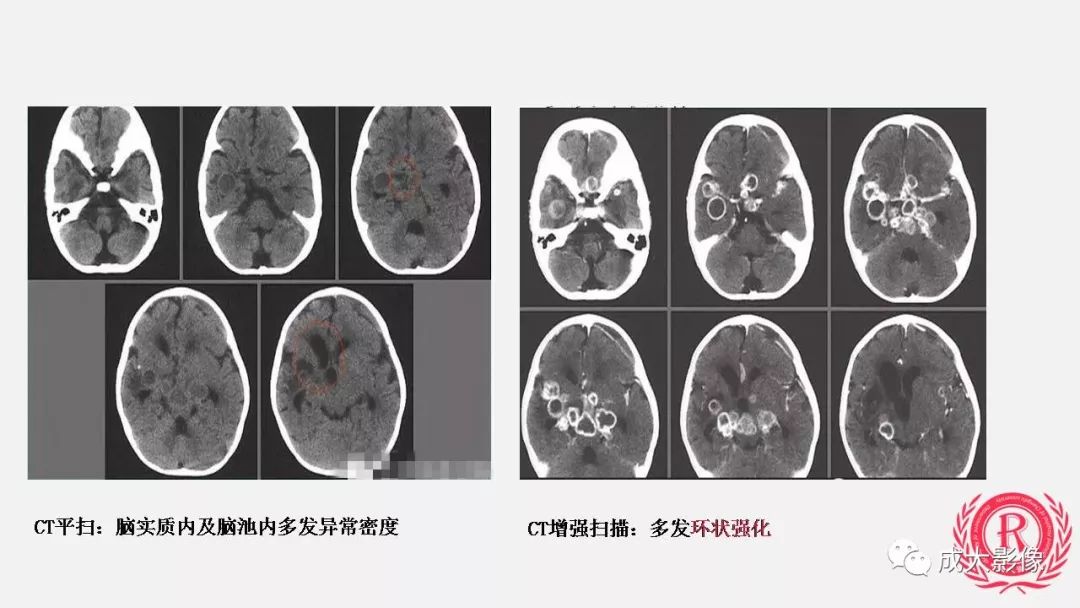 影像PPT - 【PPT】病毒性脑炎影像表现-28