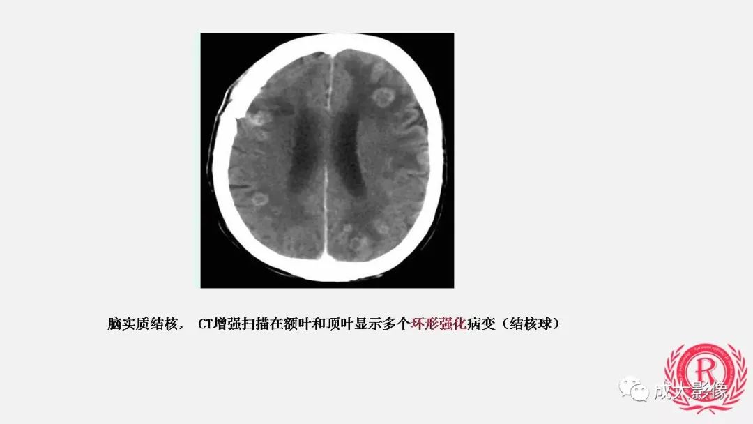 影像PPT - 【PPT】病毒性脑炎影像表现-29