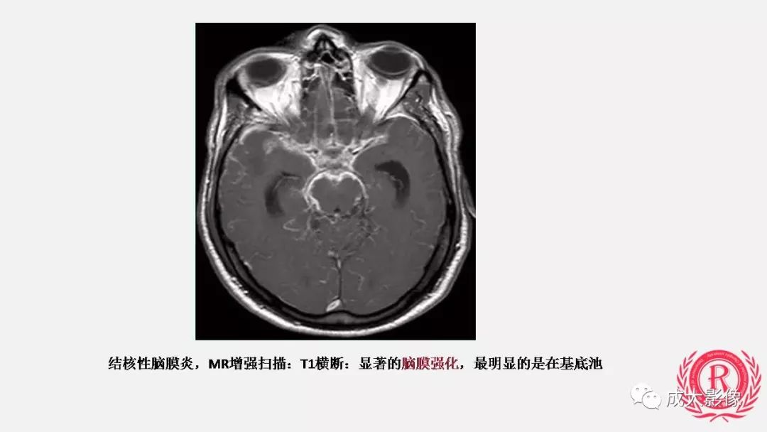 影像PPT - 【PPT】病毒性脑炎影像表现-31