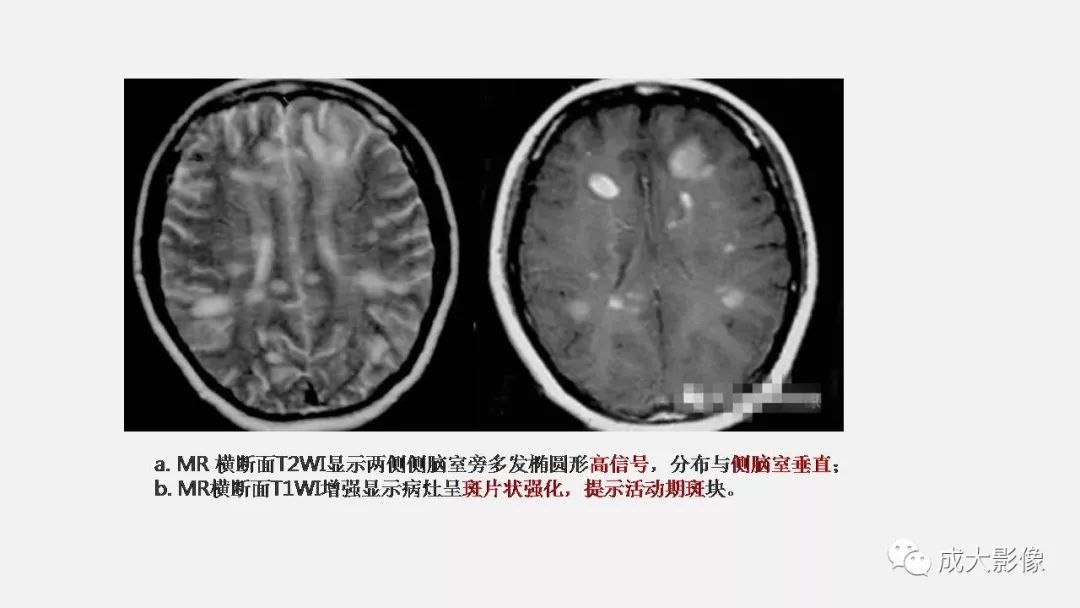 影像PPT - 【PPT】病毒性脑炎影像表现-33
